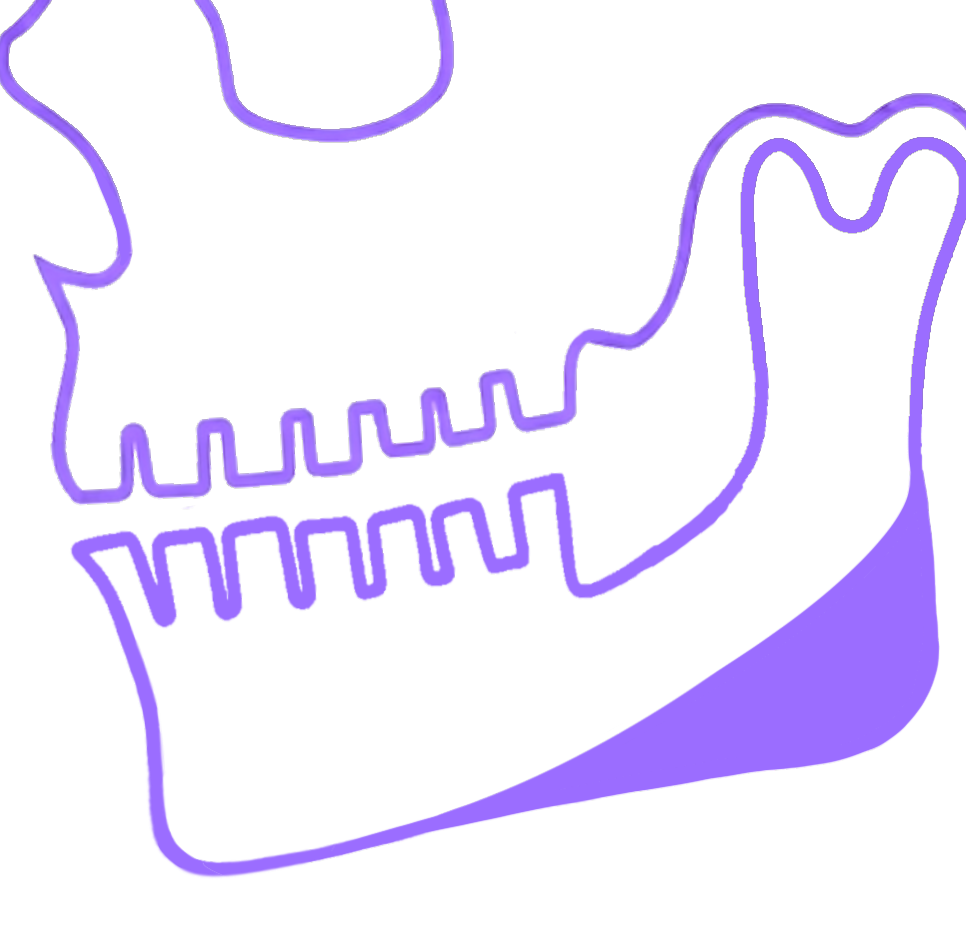 Jaw Angle Implants (Pro)